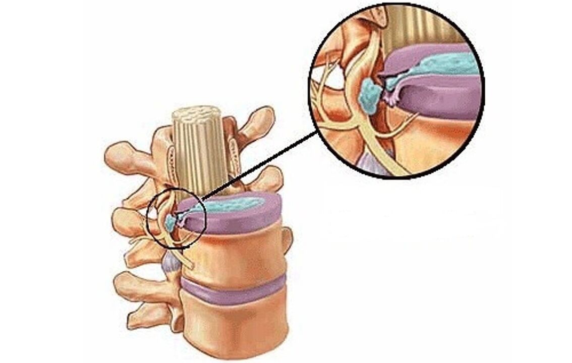 Hernia intervertebral con osteocondrose torácica